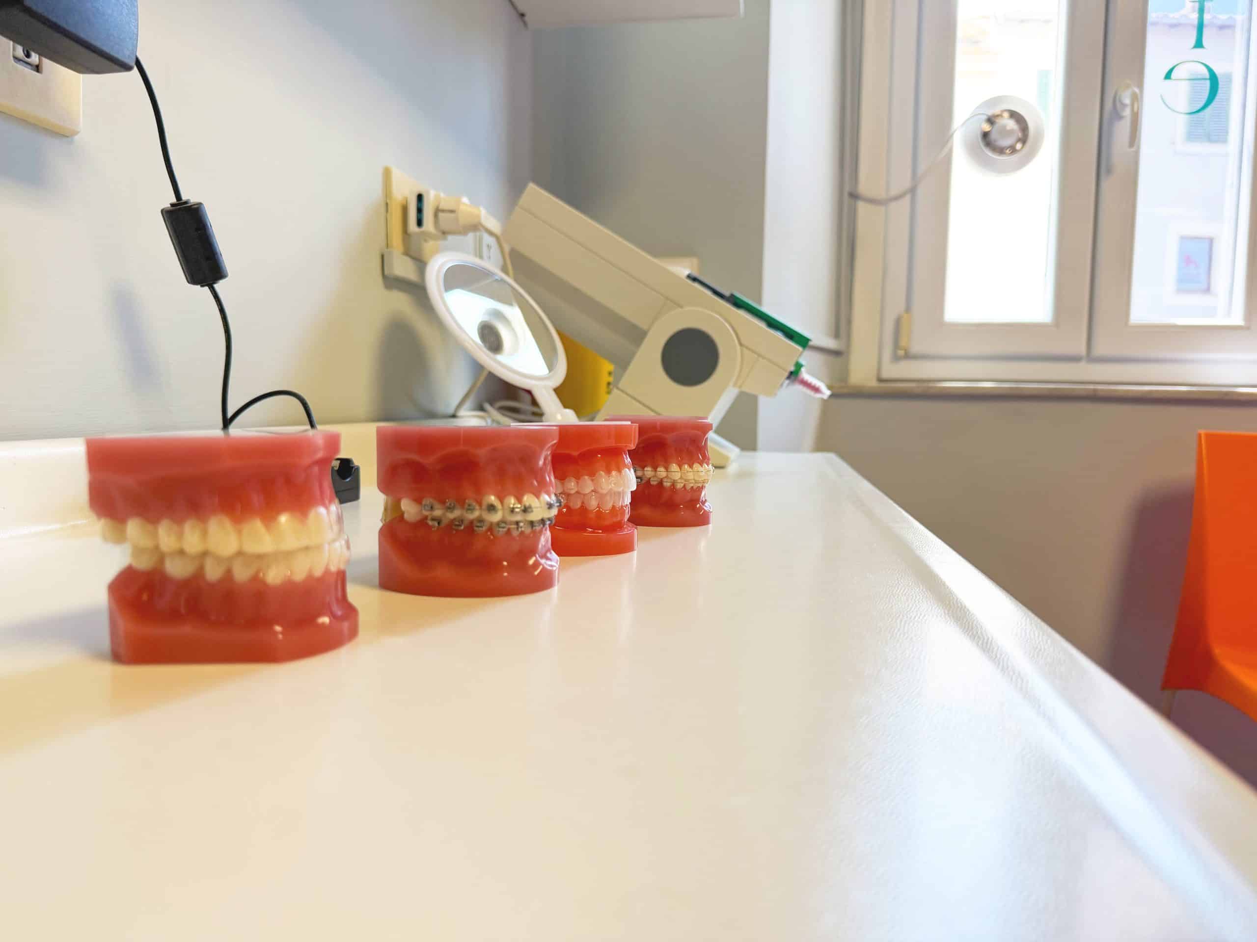 Modelli dentali con apparecchi ortodontici su un tavolo.